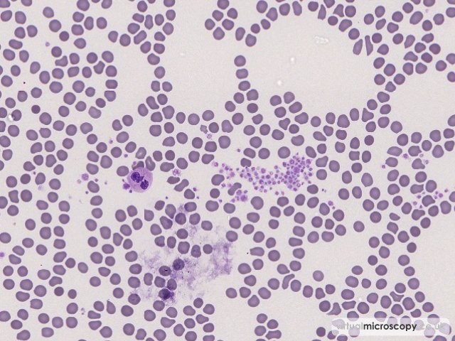 Platelet Clump - Platelet Clumping