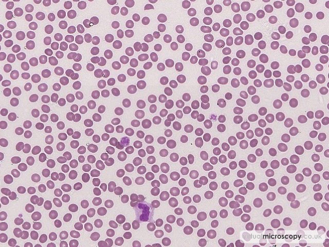 Giant Platelets - Immune Mediated Thrombocytopenia (ITP)