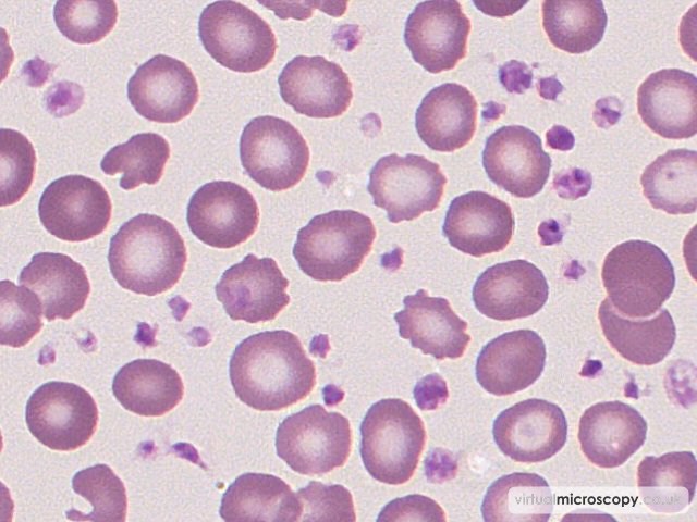 Acanthocytes - Essential Thrombocytosis
