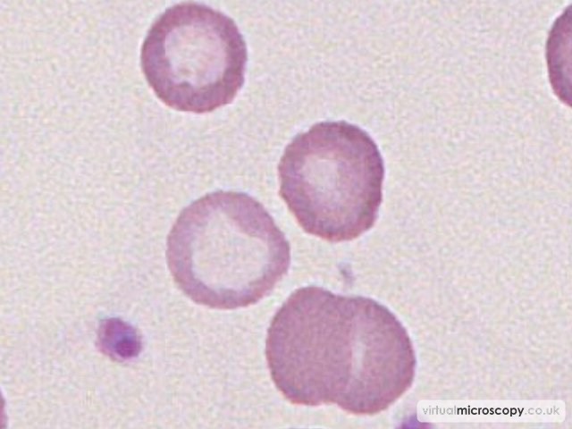 Anisochromasia - Iron Deficiency