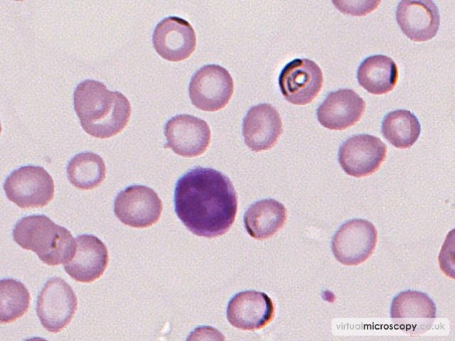 Microcytic Red Cells - Iron Deficiency