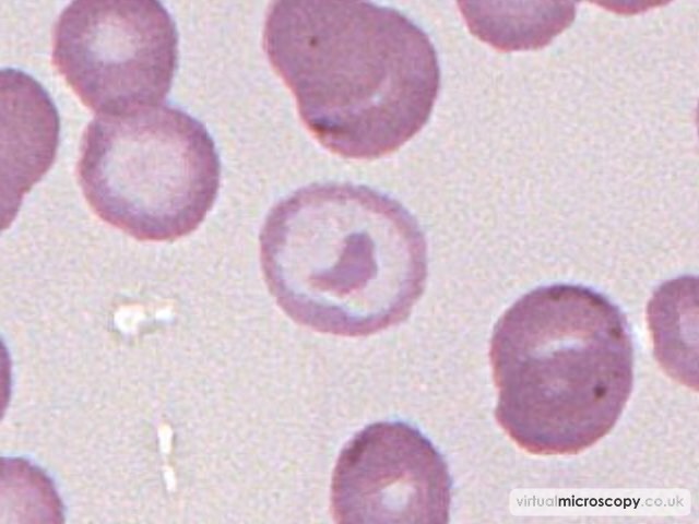 Target Cell - Iron Deficiency