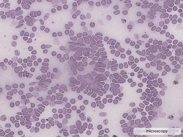 Agglutinated red cells - Cold Agglutinin Disease