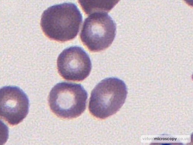 Normal Red Cells - Cold Agglutinin Disease