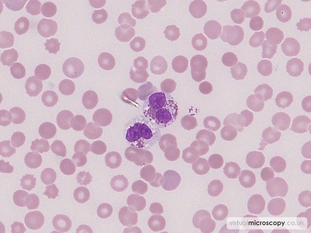 Abnormal Eosinophils - Acute Myeloid Leukaemia with Eosinophilia (Inversion 16)