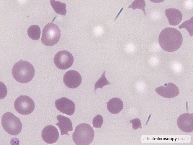 Red Cell Fragment - Thrombotic Thrombocytopenic Purpura
