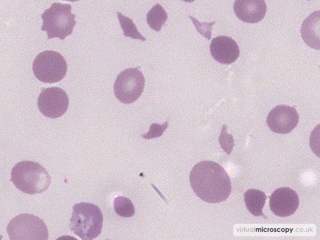 Red Cell Fragment - Thrombotic Thrombocytopenic Purpura