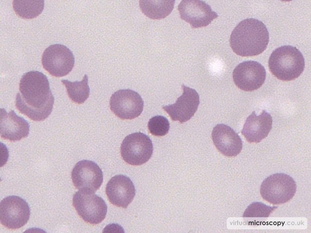 Spherocytes - Thrombotic Thrombocytopenic Purpura
