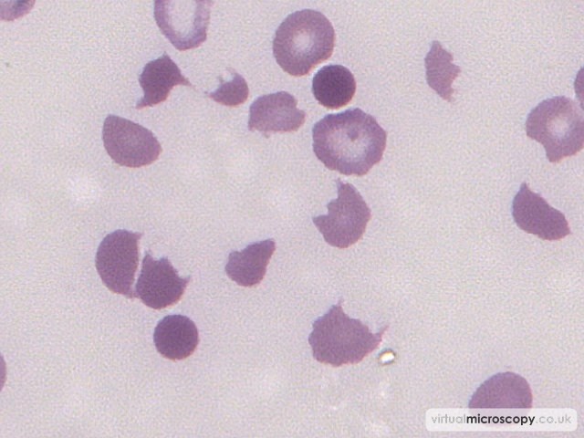 Red Cell fragments - Thrombotic Thrombocytopenic Purpura
