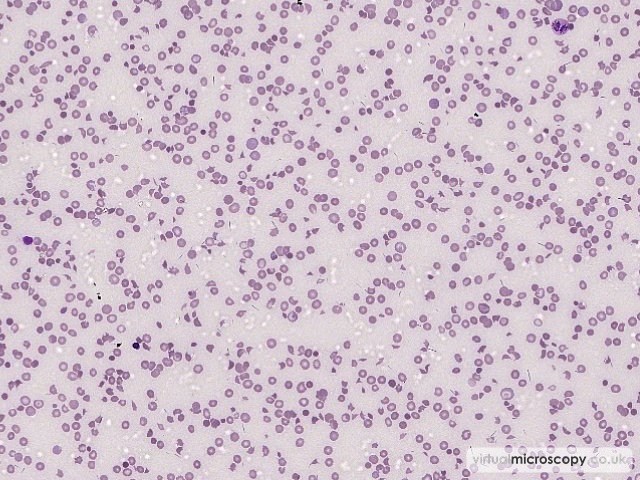 Thrombocytopenia - Thrombotic Thrombocytopenic Purpura