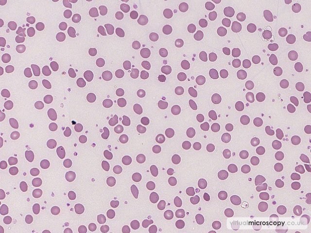 Thrombocytosis - Pyruvate Kinase Deficiency post Splenectomy