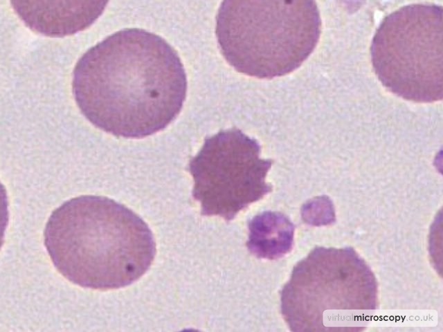 Echinocyte or Burr cell - Pyruvate Kinase Deficiency post Splenectomy