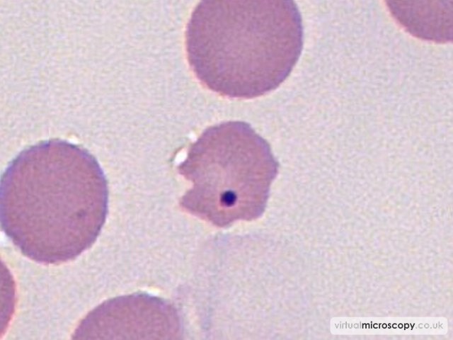 Howell Jolly Body - Pyruvate Kinase Deficiency post Splenectomy