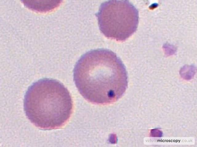 Howell Jolly Body - Pyruvate Kinase Deficiency post Splenectomy