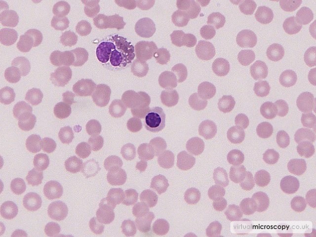Nucleated Red Blood Cell - Acute Myeloid Leukaemia with Eosinophilia (Inversion 16)