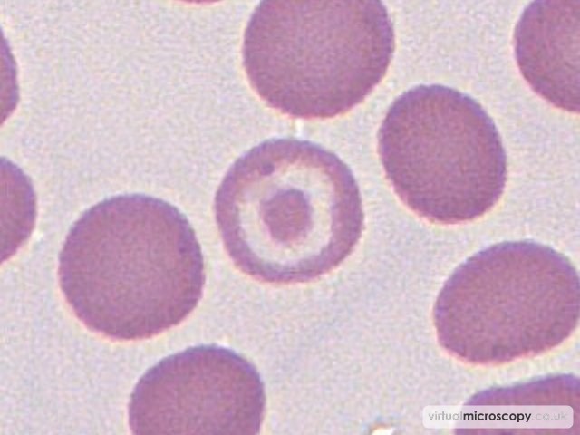 Target Cell - Pyruvate Kinase Deficiency post Splenectomy