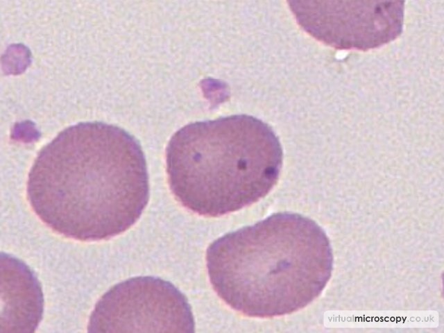 Pappenheimer Bodies - Pyruvate Kinase Deficiency post Splenectomy