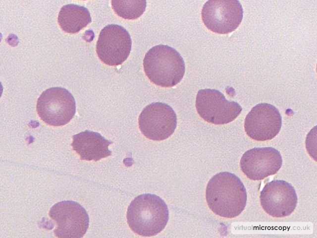 Spherocyte - Pyruvate Kinase Deficiency post Splenectomy