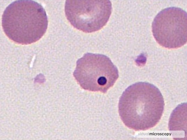 Howell Jolly Body - Pyruvate Kinase Deficiency post Splenectomy