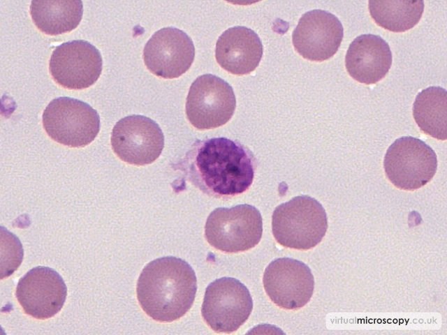 Reactive lymphocyte - Pyruvate Kinase Deficiency post Splenectomy