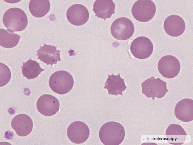 Cluster of Echinocytes - Pyruvate Kinase Deficiency post Splenectomy