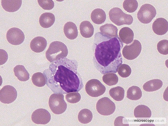 Large Granular lymphocytes - Large Granular Lymphocytic Leukaemia (LGLL)
