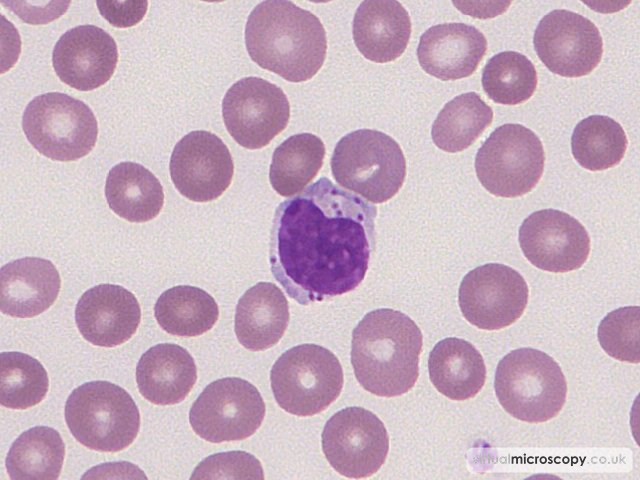 Large Granular Lymphocyte - Large Granular Lymphocytic Leukaemia (LGLL)