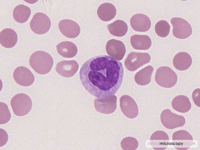 Neutrophil - Large Granular Lymphocytic Leukaemia (LGLL)