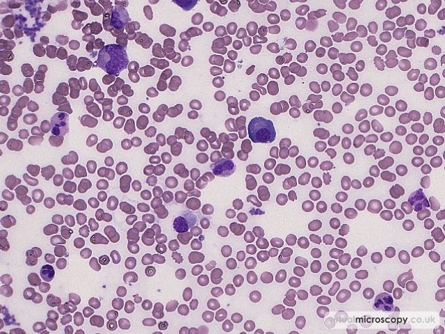 Plasma Cells (mixed morphology) - Multiple Myeloma