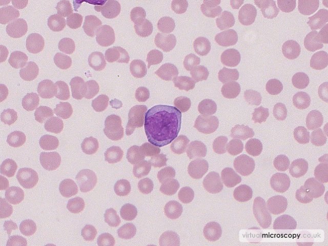 Blast - Acute Myeloid Leukaemia with Eosinophilia (Inversion 16)