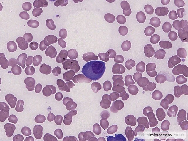 Plasma Cell - Multiple Myeloma