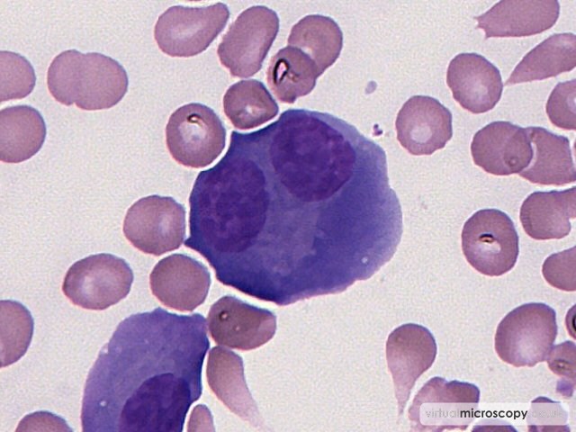 Binucleate Plasma Cell - Multiple Myeloma