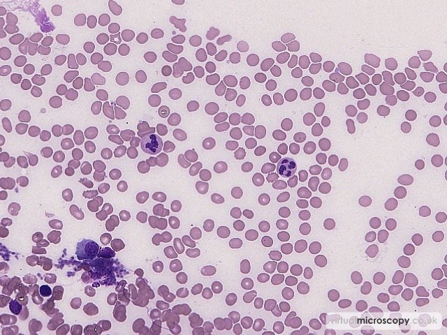 Normal Neutrophils - Multiple Myeloma