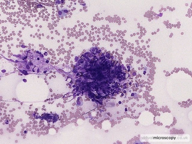Particle - Multiple Myeloma
