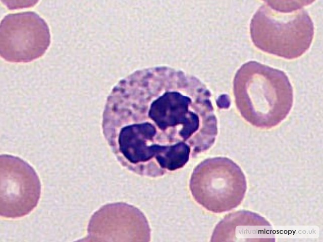 Normal Neutrophil - Low Grade B NHL