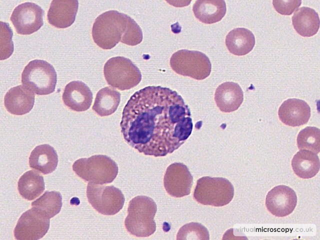 Normal Eosinophil - Low Grade B NHL