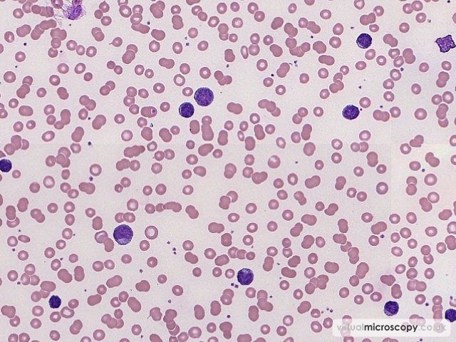 Excess Lymphoid Cells - Low Grade B NHL