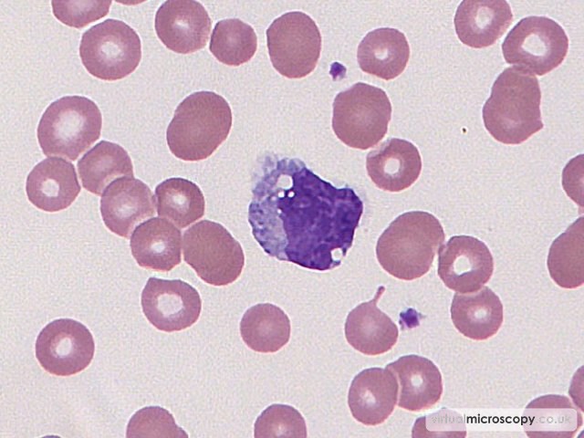 Normal Monocyte - Low Grade B NHL
