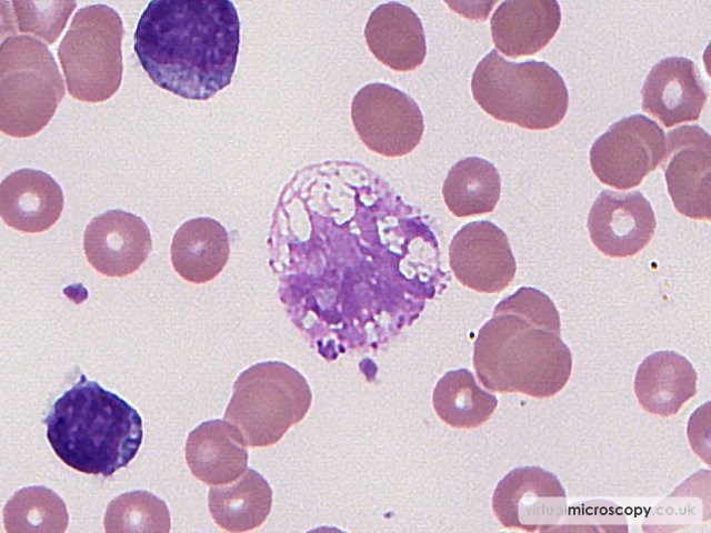 Smear Cell - Low Grade B NHL