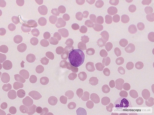 Granular Blast - Acute Myeloid Leukaemia with Eosinophilia (Inversion 16)