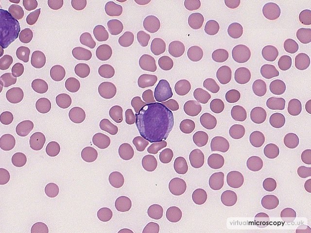 Auer Rod - Acute Monoblastic Leukaemia with Auer rods