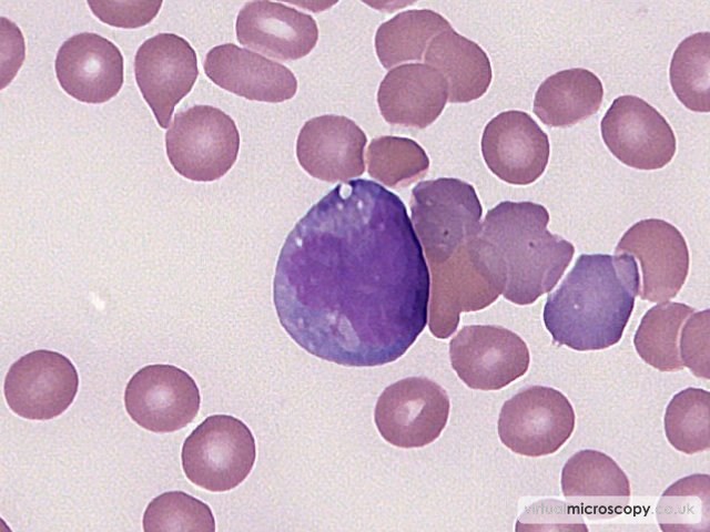 Auer Rods - Acute Monoblastic Leukaemia with Auer rods