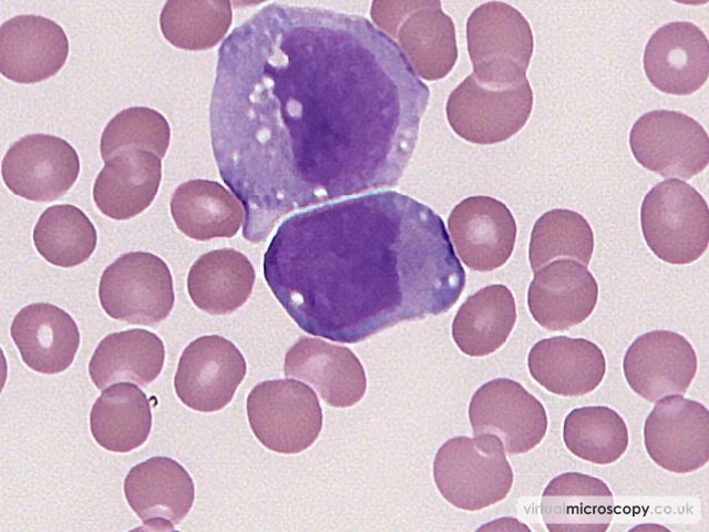 Monocytoid Blast - Acute Monoblastic Leukaemia with Auer rods
