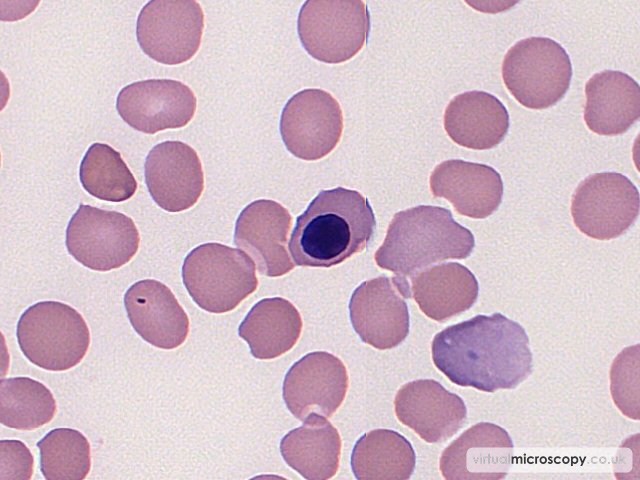 Nucleated Red Blood Cell - Acute Monoblastic Leukaemia with Auer rods