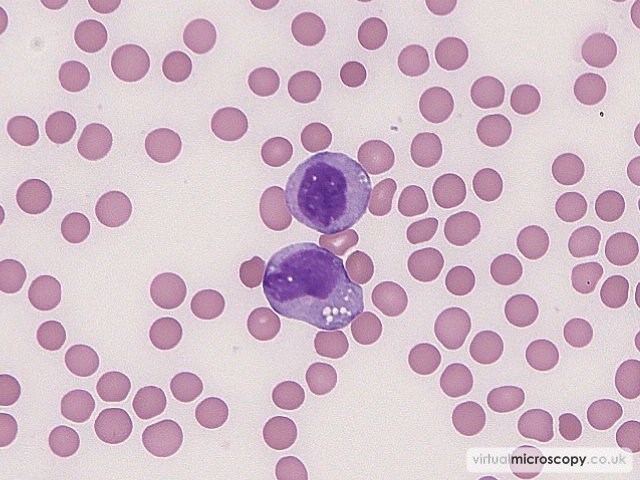 Promonocytes - Acute Monoblastic Leukaemia with Auer rods