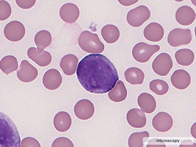 Blast - Acute Monoblastic Leukaemia with Auer rods