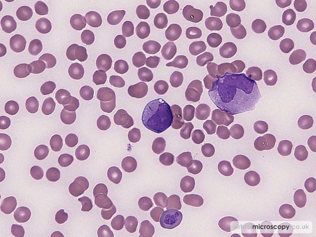 Blast with Auer rod - Acute Monoblastic Leukaemia with Auer rods
