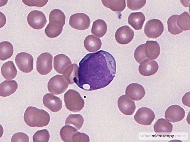 Blast with Auer Rod - Acute Monoblastic Leukaemia with Auer rods
