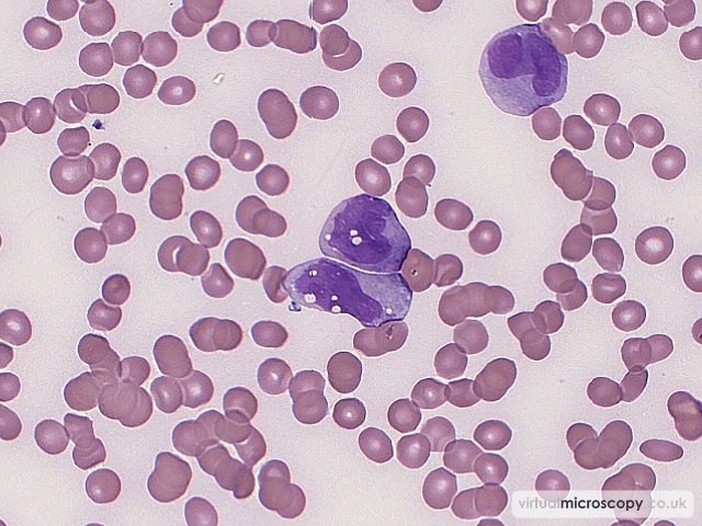 Monocytoid Blasts - Acute Monoblastic Leukaemia with Auer rods