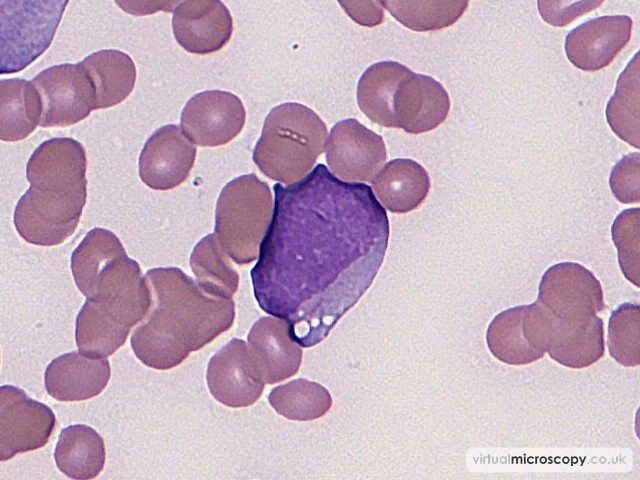 Monocytoid blast with Auer Rod - Acute Monoblastic Leukaemia with Auer rods